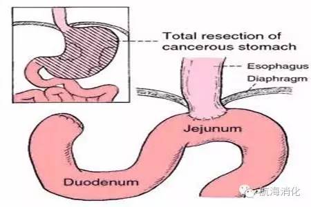 鑳冨垏闄ゆ伅鑲夊悗12灏忔椂楗,鑳冭偁鎭倝鍒囬櫎鍚庝竴鍛ㄥ悗楗
