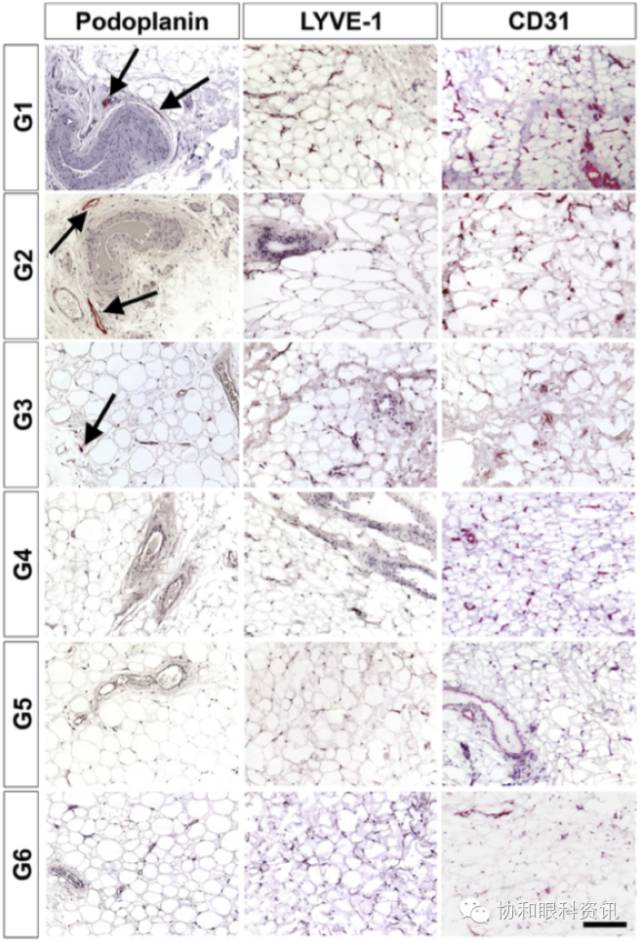 文摘速递TAO眶压升高，谁是幕后元凶？