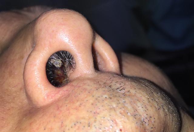 水瘊子去掉母瘊子还会长吗,肉瘊子用手抠了会怎样