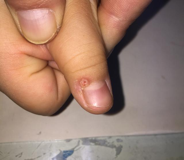 水瘊子去掉母瘊子还会长吗,肉瘊子用手抠了会怎样