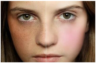 女性去褐斑的最好方法,褐青斑和黄褐斑哪种严重