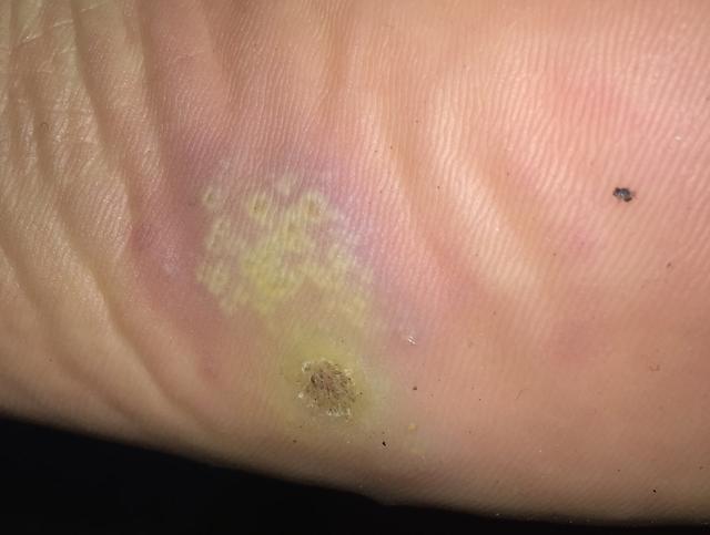 水瘊子去掉母瘊子还会长吗,肉瘊子用手抠了会怎样