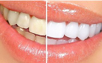 烤瓷牙里面的真牙一般几年会变黑,烤瓷牙与原来牙颜色有差异咋办