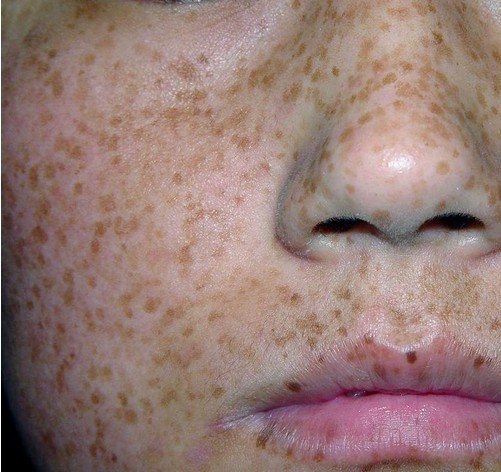 激光祛斑1-15天变化图,皮秒激光祛斑有啥副作用