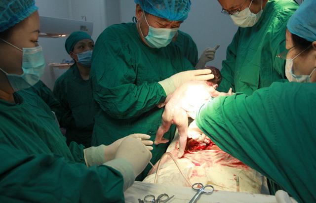 剖腹产的痛只有剖腹产的人才知道,你以为的剖腹产实际的剖腹产