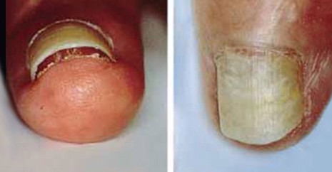 指甲的变化意味着身体的健康状况,指甲上出现这7症状是大病预兆