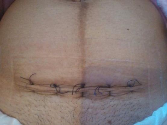 剖腹产的痛只有剖腹产的人才知道,你以为的剖腹产实际的剖腹产