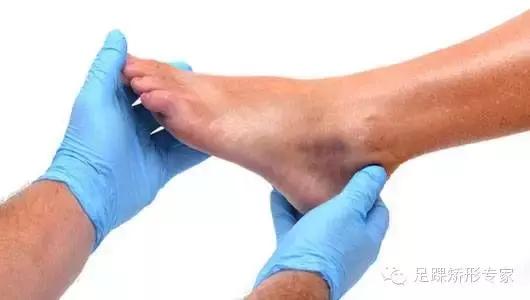 足踝扭伤韧带撕裂的恢复过程,扭伤足踝如何快速恢复