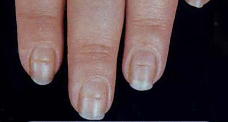指甲的变化意味着身体的健康状况,指甲上出现这7症状是大病预兆