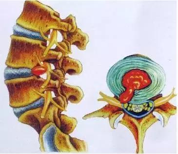 解决腰痛的腰椎锻炼方法,练一下腰椎的操