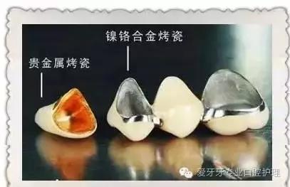 烤瓷牙和全瓷牙的区别和价格,贵的烤瓷牙和便宜的有区别吗