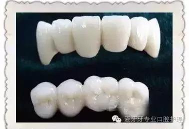 烤瓷牙和全瓷牙的区别和价格,贵的烤瓷牙和便宜的有区别吗