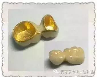 烤瓷牙和全瓷牙的区别和价格,贵的烤瓷牙和便宜的有区别吗