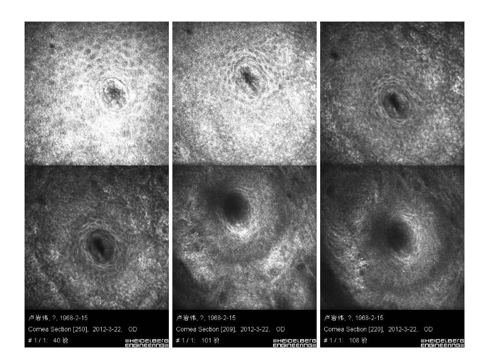 眼睑缘炎的发病原因,眼睑炎的症状和治疗方法