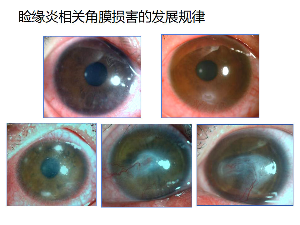 眼睑缘炎的发病原因,眼睑炎的症状和治疗方法