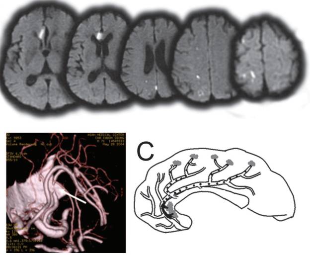 大脑前动脉梗死属于小动脉梗死吗,左侧大脑中动脉闭塞大面积梗死