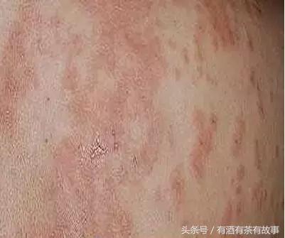 湿疹过敏超级痒,宝宝过敏湿疹妈妈怎么忌口