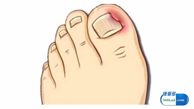 甲沟炎破坏甲床手术需要多少钱,甲沟炎手术怎样治疗能彻底根除