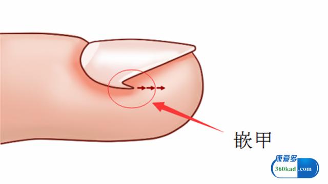 甲沟炎破坏甲床手术需要多少钱,甲沟炎手术怎样治疗能彻底根除