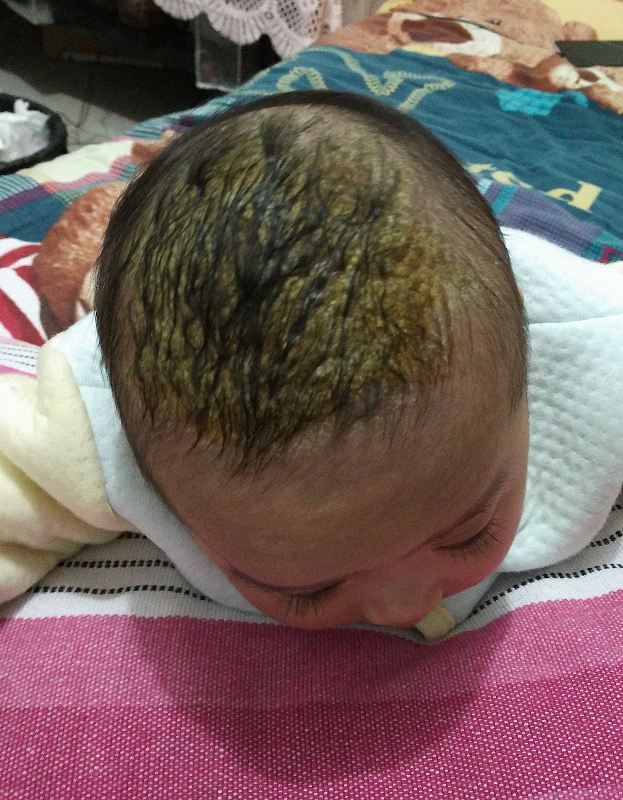 宝宝奶痂几个月才掉,一个月的宝宝长奶痂用什么治疗