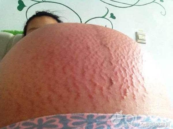 孕期皮肤瘙痒一挠就起小疙瘩,孕期准妈妈身体出现问题