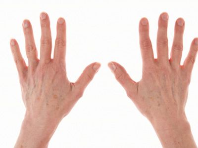 湿疹的病因与发病机制及临床表现,皲裂性湿疹的病因可以查到吗