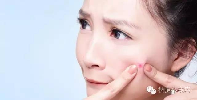 脸颊长痘物理消痘法,长痘月球脸怎么形成的