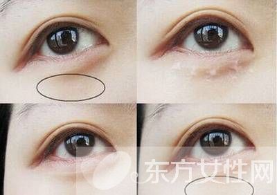 眼部的脂肪粒怎么去除小窍门,眼部长脂肪粒怎样才能除去脂肪粒