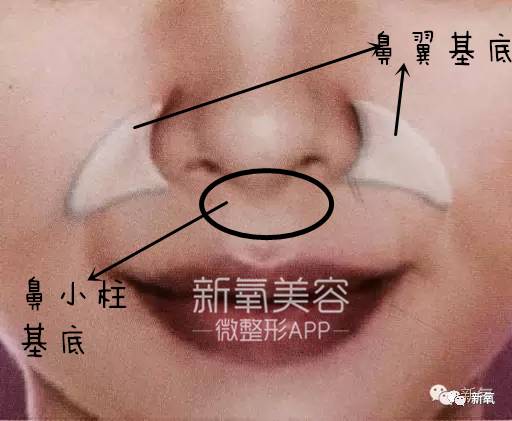 林允整牙却像整容？她是真的又整了啊！