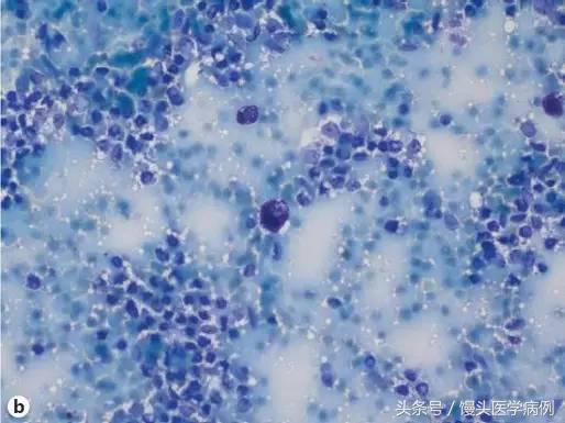 卵巢肿瘤穿刺活检结果,卵巢囊肿穿刺从哪穿刺