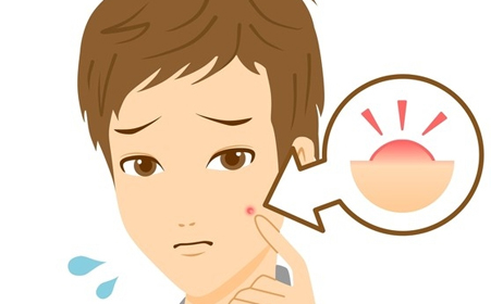 祛痘痘的药膏过敏怎么办,青春痘抹了药变红起皮还很疼