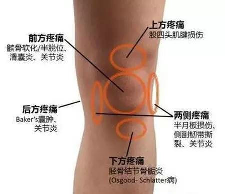 髌骨软化症最佳的治疗方法,夹球可以锻炼髌骨软化症吗