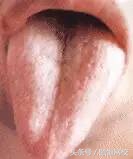 中医舌诊图谱100例,靠谱中医史上最全高清舌诊图谱