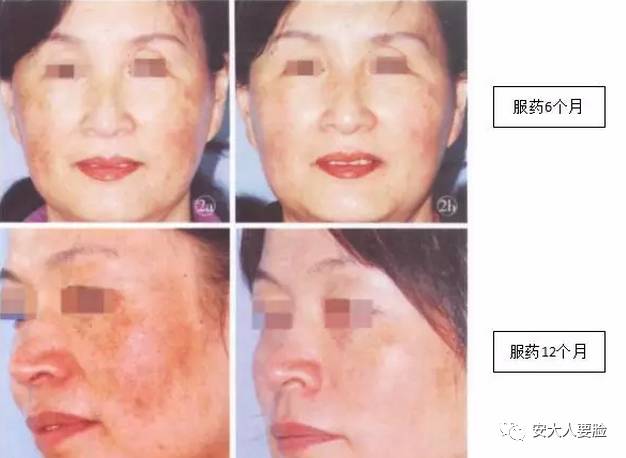 美白丸美白饮真的有效果吗,什么牌子的美白丸最有效果