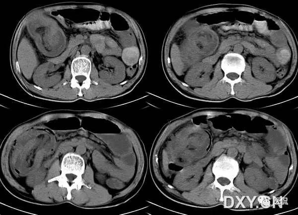 消化系统钡餐造影的直接征象,消化系统影像学诊断手册基础知识
