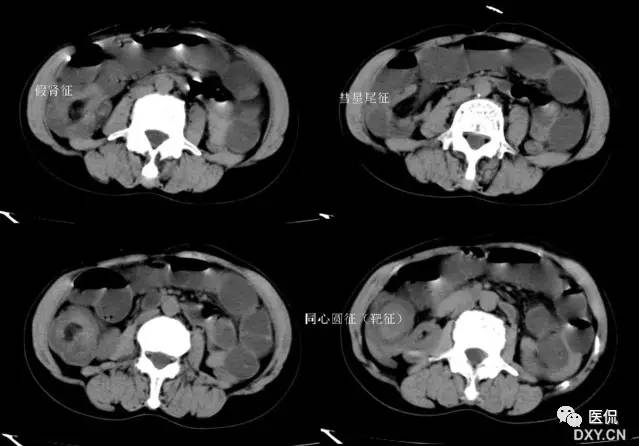 消化系统钡餐造影的直接征象,消化系统影像学诊断手册基础知识