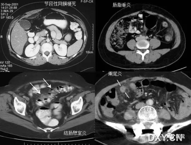 消化系统钡餐造影的直接征象,消化系统影像学诊断手册基础知识