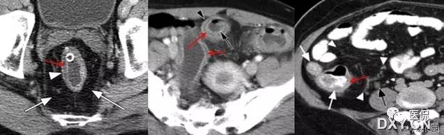 消化系统钡餐造影的直接征象,消化系统影像学诊断手册基础知识