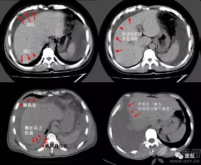 影像学呼吸系统理论知识,呼吸系统疾病影像学常见征象