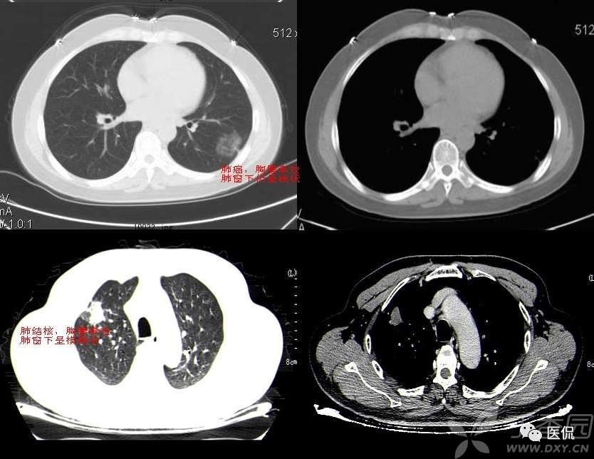 影像学呼吸系统理论知识,呼吸系统疾病影像学常见征象