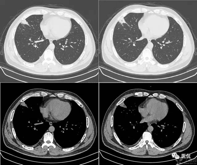 影像学呼吸系统理论知识,呼吸系统疾病影像学常见征象