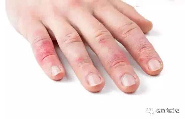 「健康向前进」冻疮我该如何跟你说ByeBye