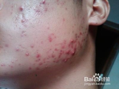 长痘痘怎么办快速消痘男士,长痘痘期间该吃什么可以消除痘痘