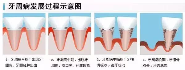 牙套黑三角要不要片切,戴牙套会出现黑三角后怎么恢复