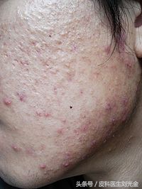 疮疖和毛囊炎的区别,毛囊炎和湿疹的区别