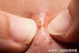 皮肤科医生毛孔粗大有黑头,黑头毛孔粗大看皮肤科有用吗