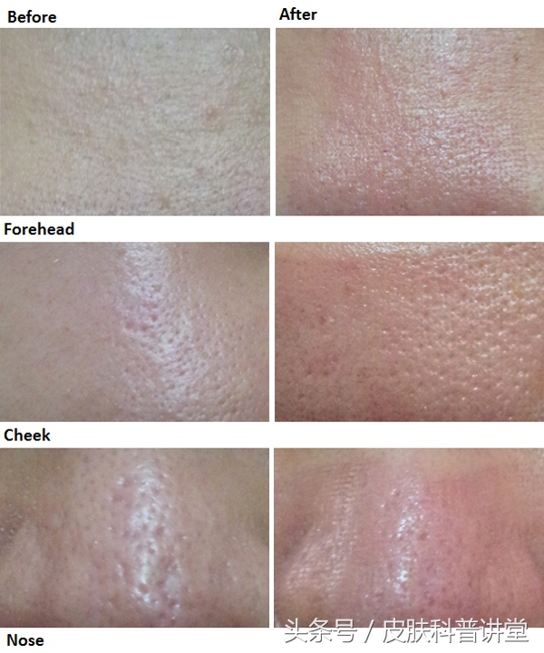 皮肤科医生毛孔粗大有黑头,黑头毛孔粗大看皮肤科有用吗