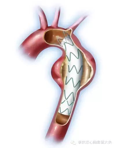 主动脉夹层最凶险的并发症,人体最凶险的主动脉夹层