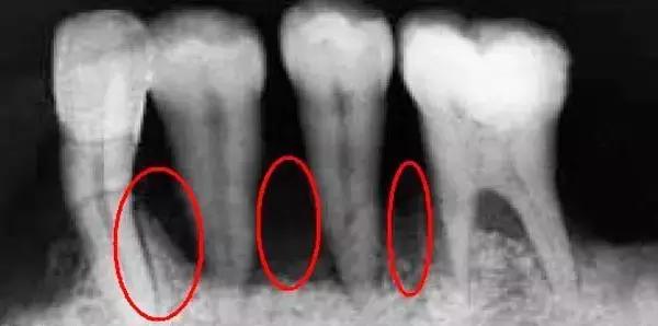 牙套黑三角要不要片切,戴牙套会出现黑三角后怎么恢复