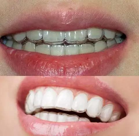 整牙=整容？看杨幂、刘涛、高圆圆为你亲身示范！